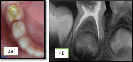 A,B: Intraoral photograph and IOPA after pulpectomy