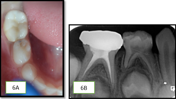 A,B: Cementation done