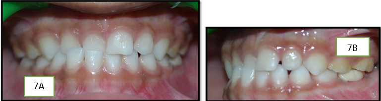 A,B: Occlusion was checked