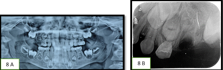 A: Pre-operative OPG; B: Pre-operative IOPA