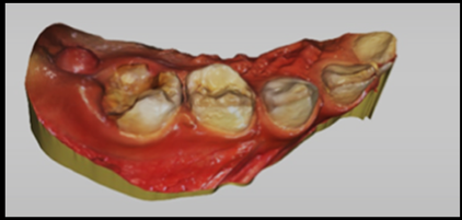Digital scan using the CEREC Omnicam scanner