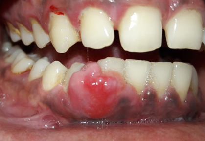 Soft tissue growth WRT mandibular canine and premolar region