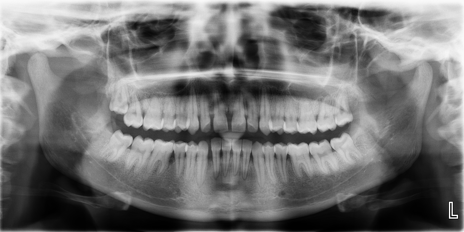OPG showing localized bone loss in the region