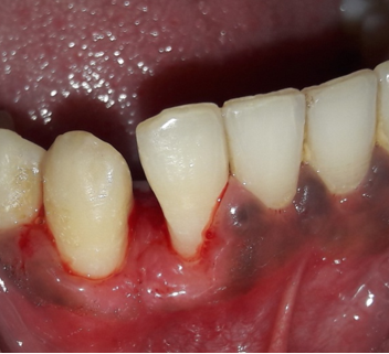 After surgical excision