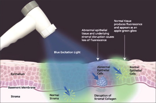 Diagram depicting the interaction of blue excitation light with normal and abnormal mucosa which results in FVR and FVL respectively when viewed through the VELscope handpiece. Adapted from VELscope enhanced oral assessment