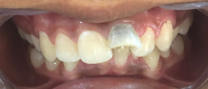 Showing fractured tooth with black discolouration