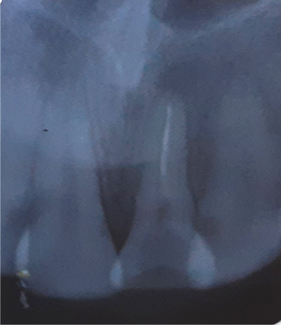 Showing presence of needle obstruction n canal