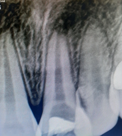 Showing removal of needle