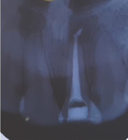 Showing obturation of tooth with apical puff