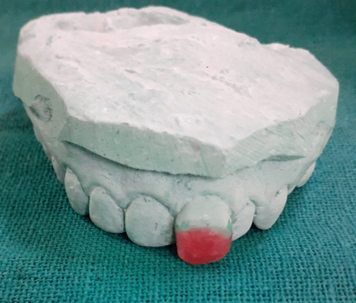 Showing wax build up of fractured segment