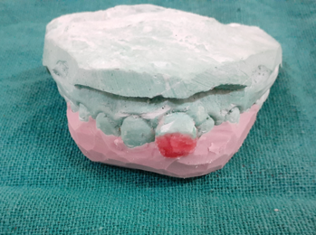 Showing putty impression as a template n cast