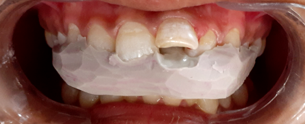 Showing putty impression as a template in mouth