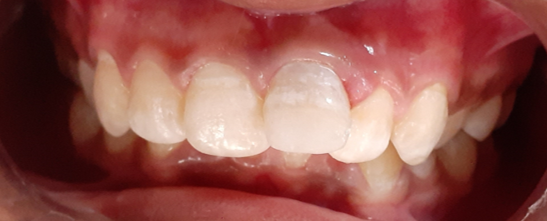 Showing post build up
