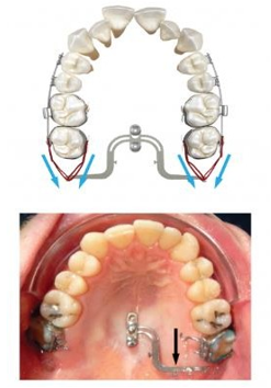 Bilateral and unilateral distalizing effect of D-plate