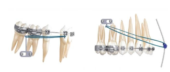 E-plate in action applying forces similar to elastics and can be used in combination with skeletal anchorage devices.
