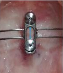 Leeway space for implants in CTOR plate