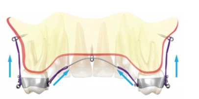 Intrusive forces acing on maxillary posteriors