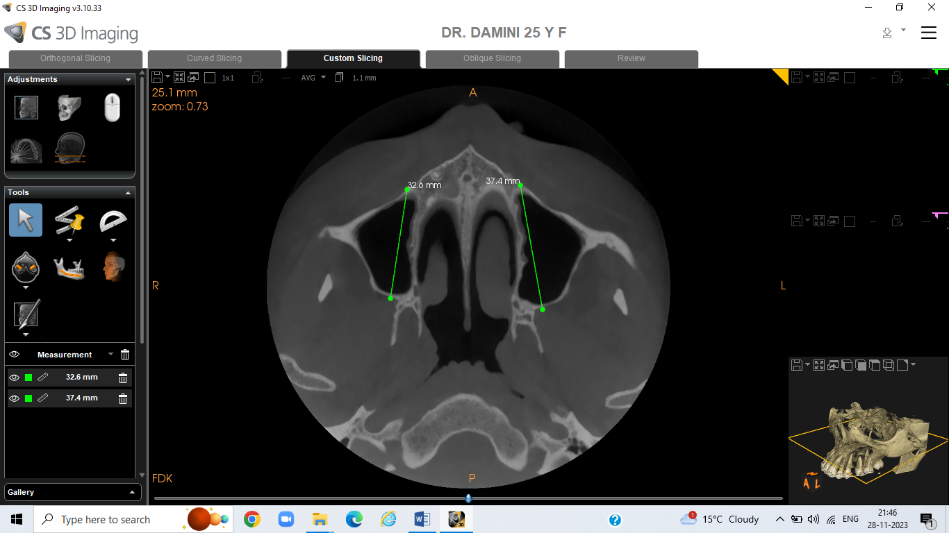 Tracing by using cs3d 3.10 software showing maxillary sinus hypoplasia in CBCT
