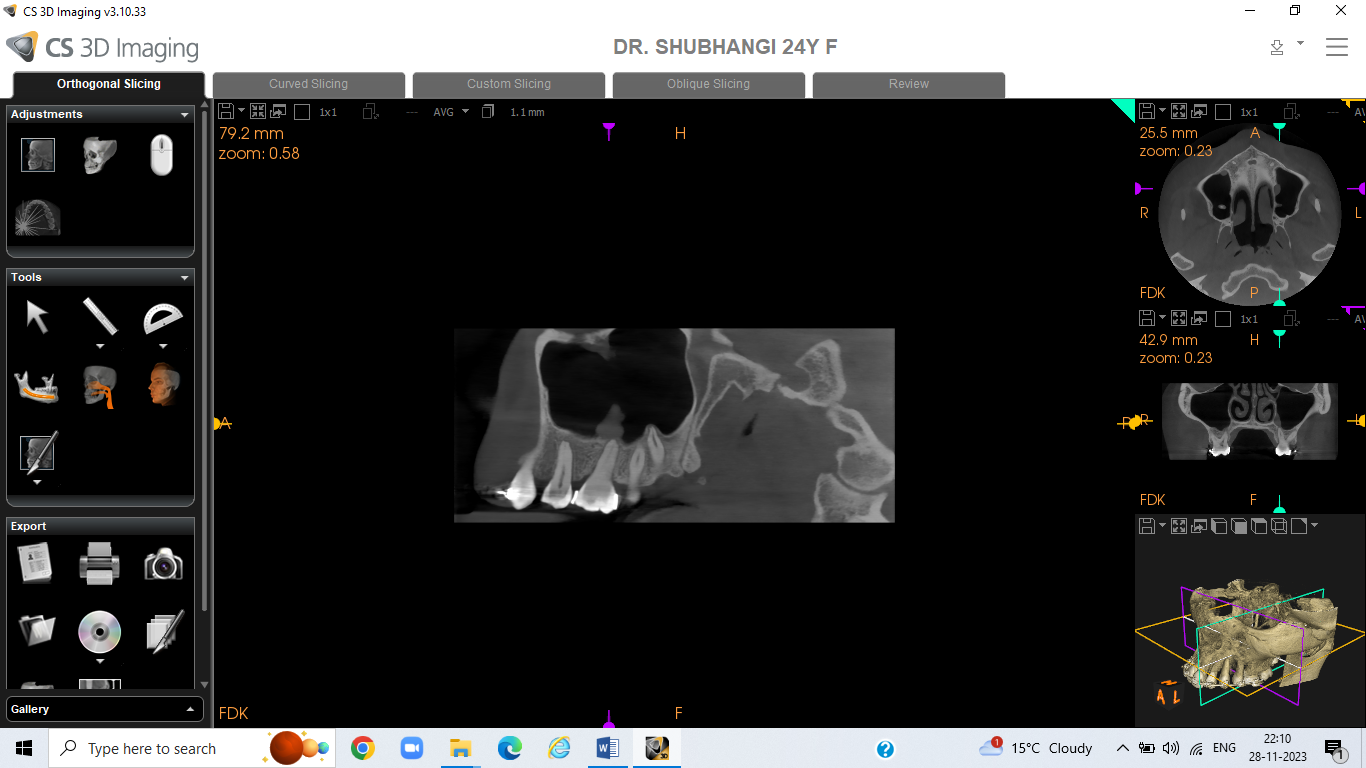 Tracing by using cs3d 3.10 software showing enostosis in maxillary sinus in CBCT