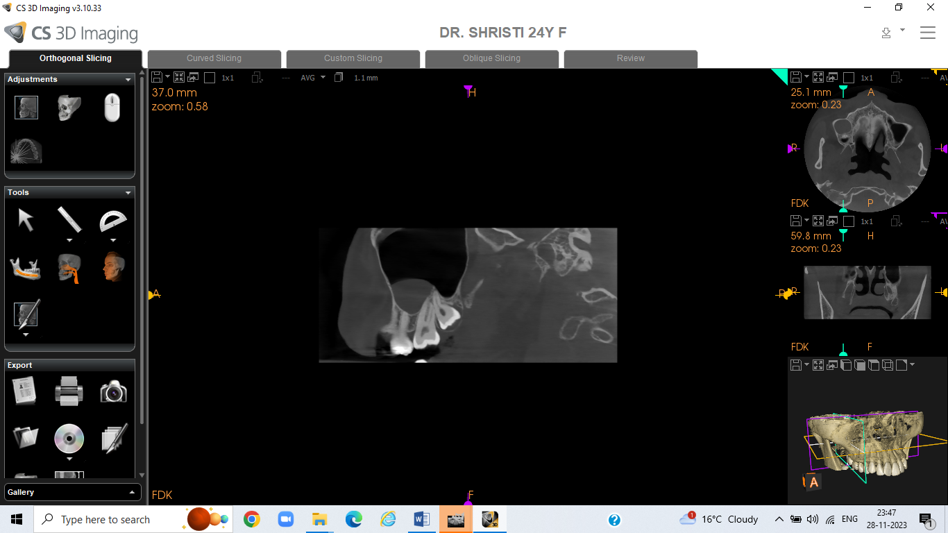 Tracing by using cs3d 3.10 software showing maxillary sinus polyp in CBCT