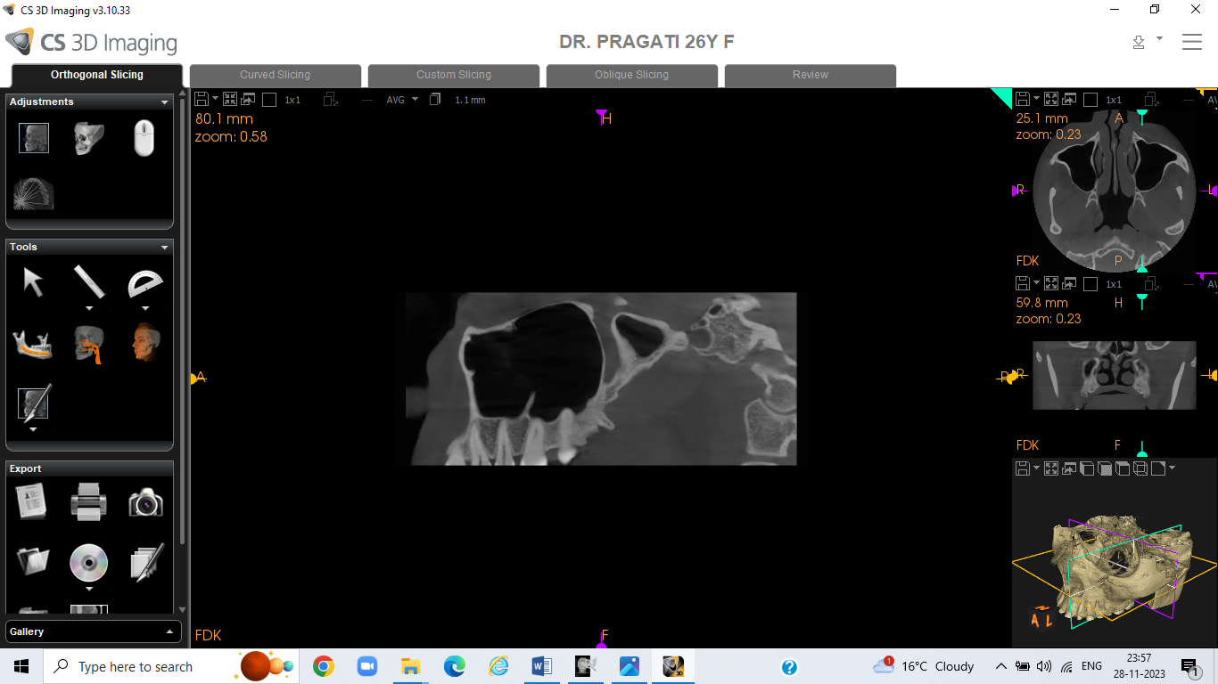 Tracing in CBCT by using cs3d 3.10 software for septa in maxillary sinus