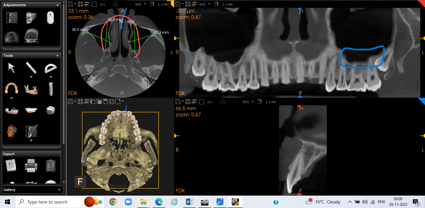 Tracing in CBCT by using cs3d 3.10 software for mucosal thickening of maxillary sinusitis