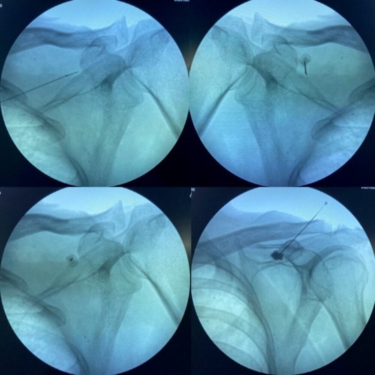 Image showing the fluoroscopic view of supra-scapular notch and needle entering the notch and confirmation with contrast dye