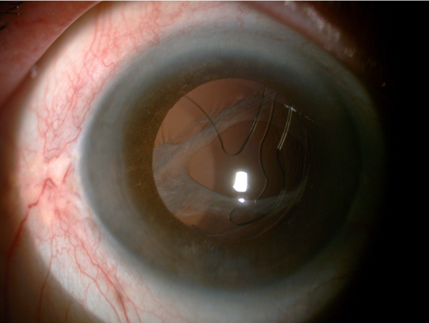 Showing decentred IOL post Yag Capsulotomy