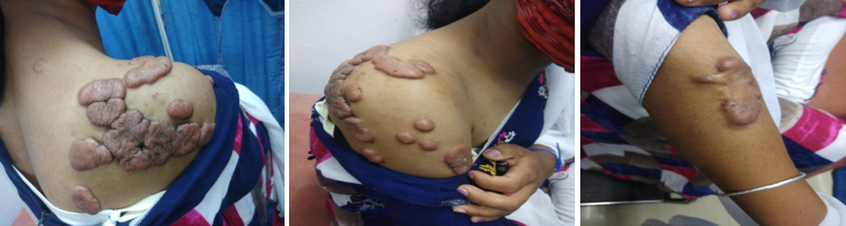 Clinical pic showing multiple scars in the shoulder, upper arm and forearm.