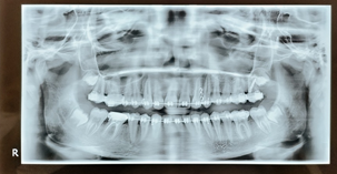 OPG with after placement of IZC implant