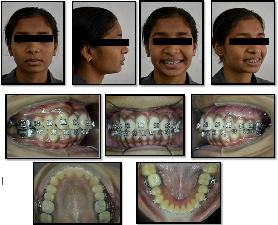 Post-distalization stage photographs