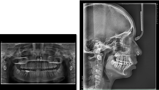 Post treatment radiographs