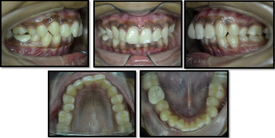 Pre-treatment intra-oral photographs