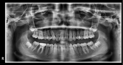 Pre-treatment panoramic radiograph 