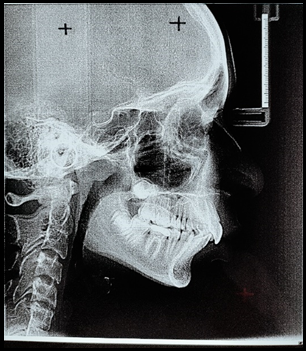 Pre-treatment lateral cephalogram