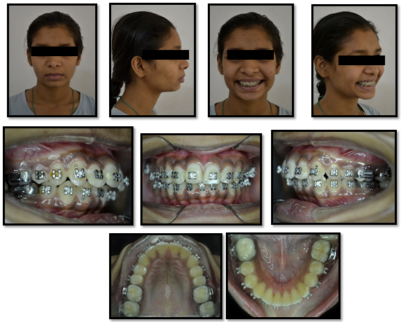 Pre-distalization photograhs