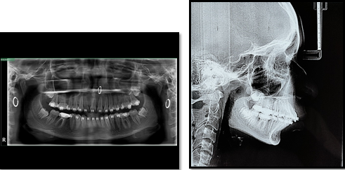 Pre-Distalization stage radiographs