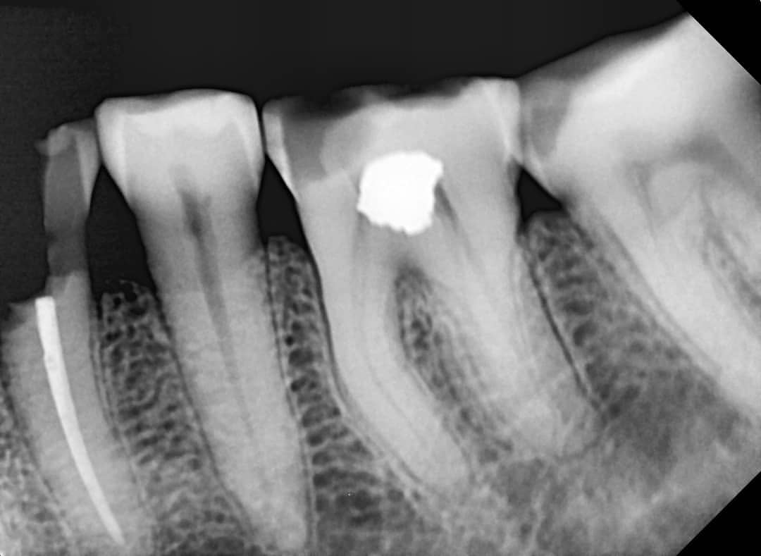 Clinical Management Of The Split Tooth In A Diabetic Patient IJOHD clinical-management-of-the-split-tooth-in-a-diabetic-patient-ijohd