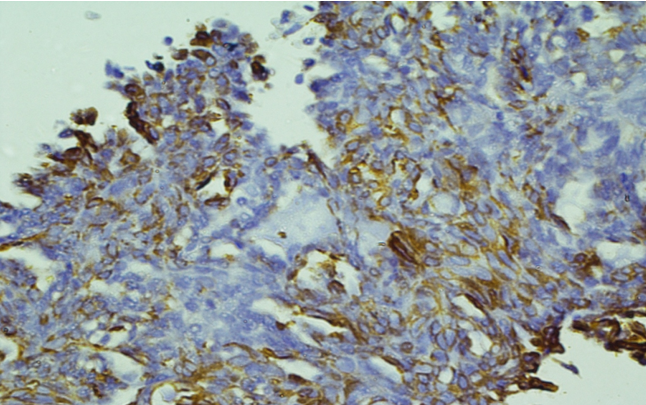 Immunohistochemical expression of PAX-8 showed strong membranous positivity of tumors cells. IHC PAX-8 x10X.