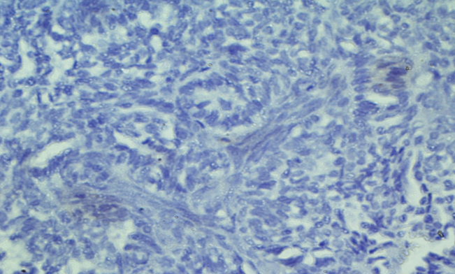 Immunohistochemistry showed negative expression of TTF-1 in tumors cells. IHC TTF-1x 10X. 