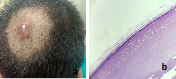 a: Trichilemmal cyst on the scalp of 32 year old male; b: Histopathology of Trichilemmal cyst shows cyst wall with trichilemmal differentiation.