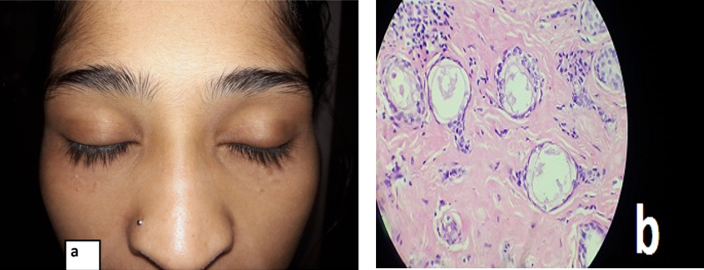 a: Syringoma in a 18-year-old female; b: Histopathology of syringoma showing cords of epithelial resembling tadpole (H & E satin, 100X)