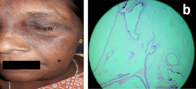 a: Hidrocystoma on the upper eyelid in a 56 year old female; b: Histopathology of Hidrocystoma showing multilocular cystic lined by bilaminar epithelium.
