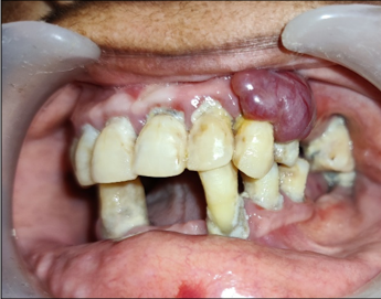 Preoperative intraoral lesion