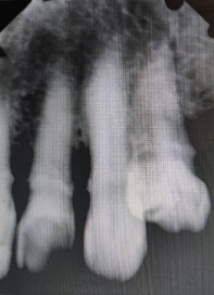 Pre-op radiograph