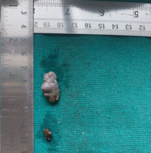 Measurement of excised mass