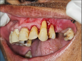 Post-operative view after 1 week