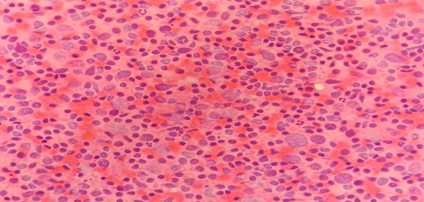 Photomicrograph of the inguinal lymph node showing polymorphous population of lymphoid cells. Some of the cells show mild nuclear enlargement and opened up chromatin. No granuloma or any definite Reed- Sternberg cells are seen (H/E stain, 400X)