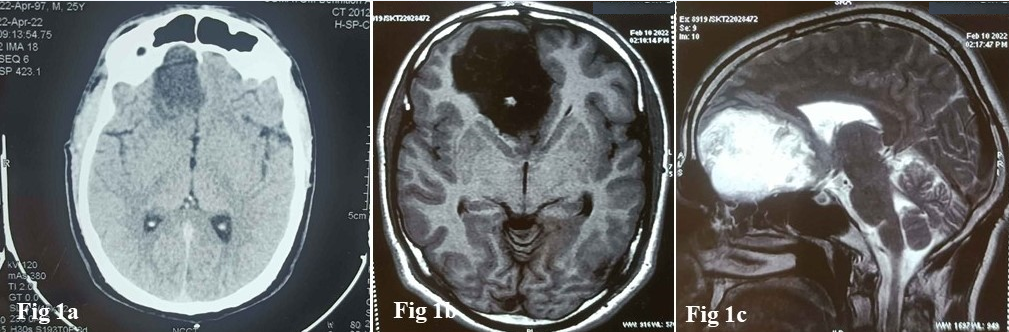 a: Non-Contrast Computed Tomography (NCCT) scan showing a hypodense mass in right frontal lobe extending upto midline; b: Magnetic resonance imaging (MRI) showing a hypointense lesion in right frontal lobe with irregular margins; c: Showing a hyperintense mass in right frontal lobe with variegated appearance