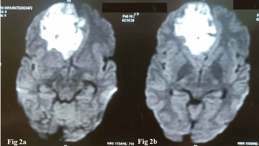 a,b: Diffusion weighted images (DWI) showing a hyperintense mass in right frontal lobe with restricted diffusion